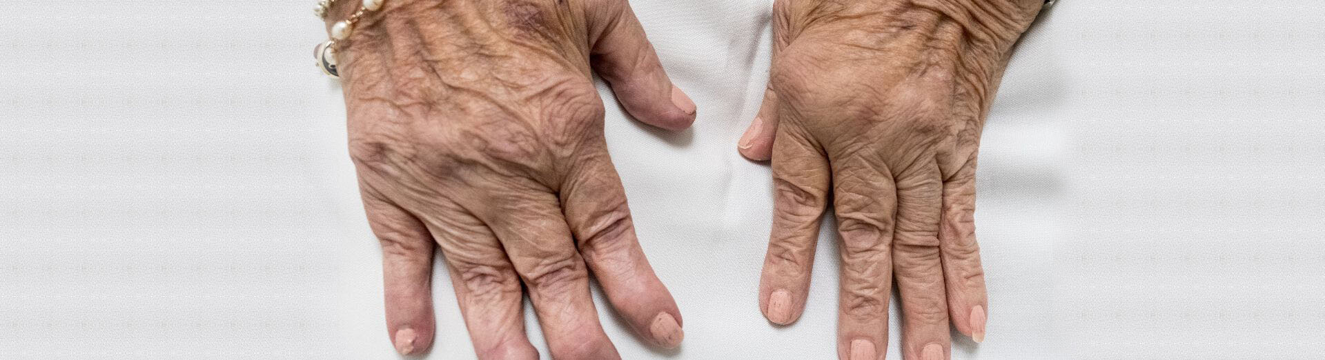 Rheumatoid Rehabilitation
